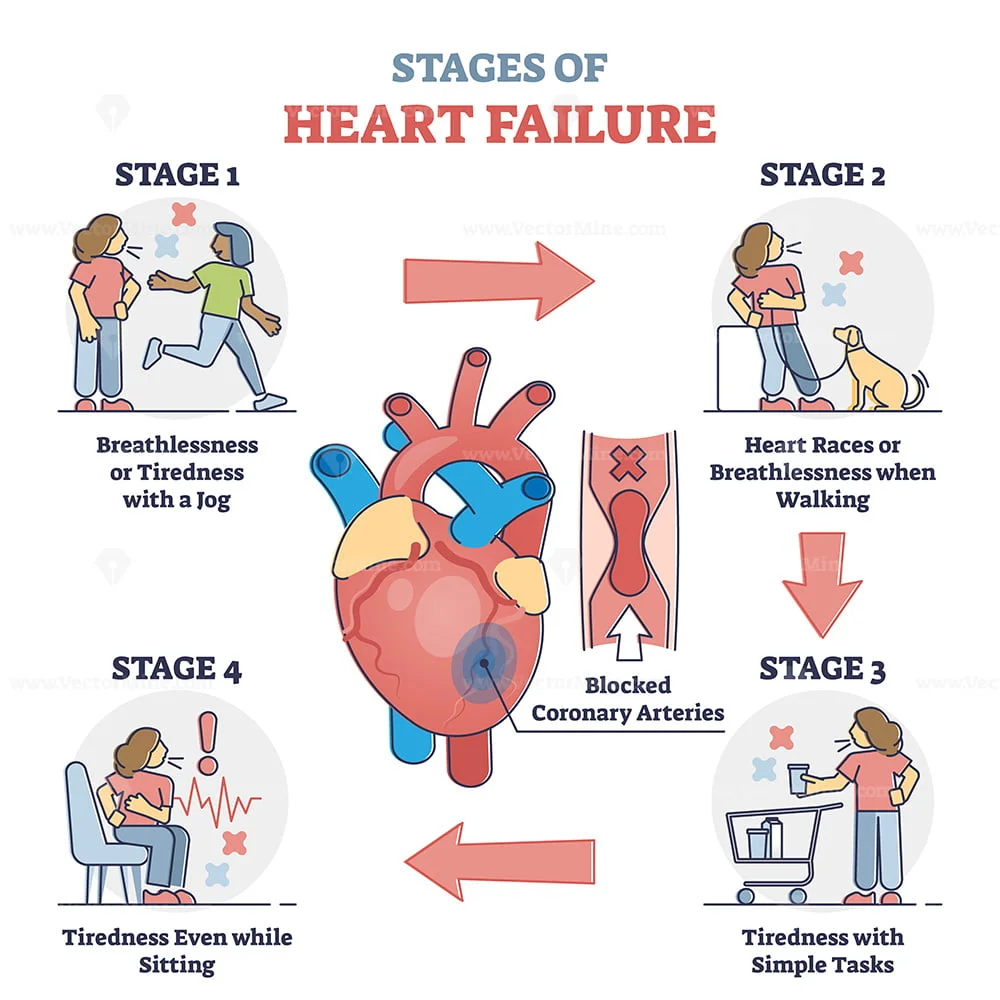 Stages Of Heart Failure And Symptoms With Cardiology Stroke Outline Diagram VectorMine