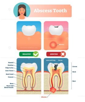 Abscess Tooth