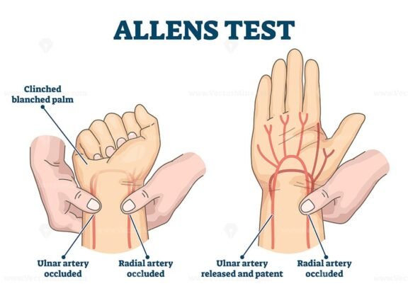Allens Test