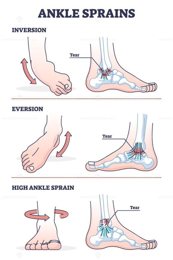 Ankle Sprains outline
