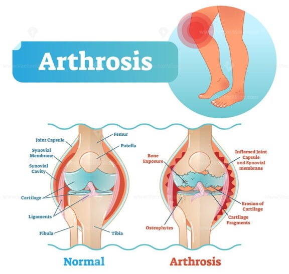 Arthrosis