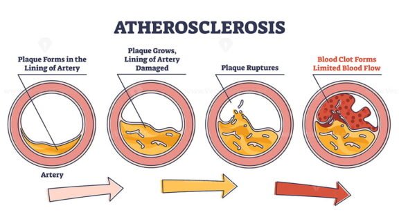 Atherosclerosis outline