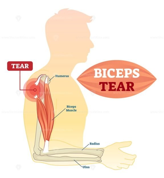 Biceps Tear