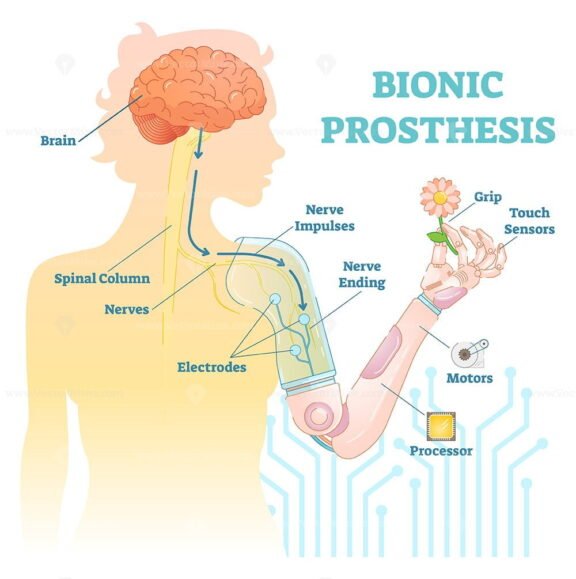 Bionic Prosthesis