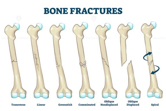 Bone Fractures