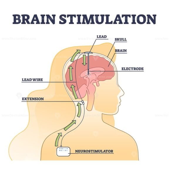 Brain Stimulation outline