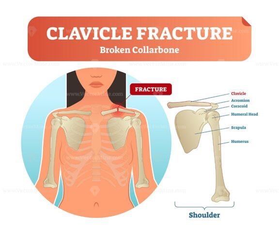 CLAVICLE Fracture