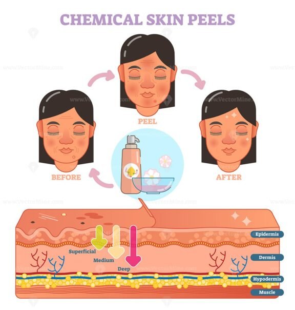 Chemical Skin Peels