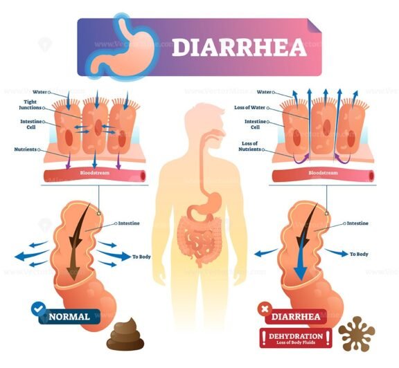 Diarrhea diagram