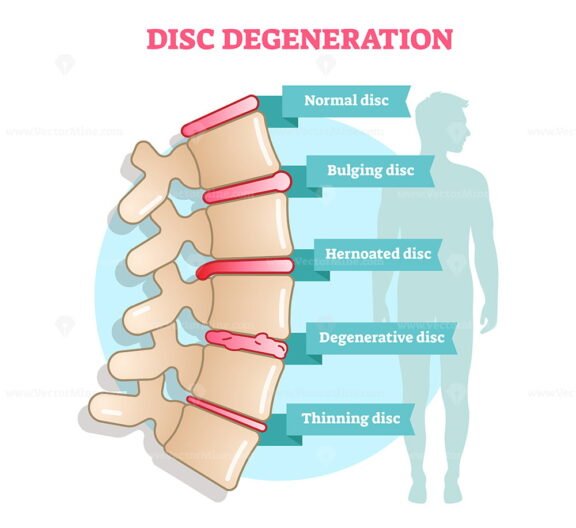 Disc Degeneration