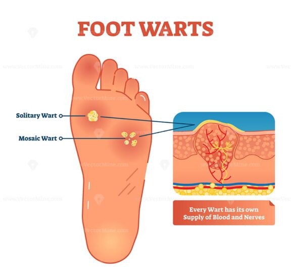 Foot Warts