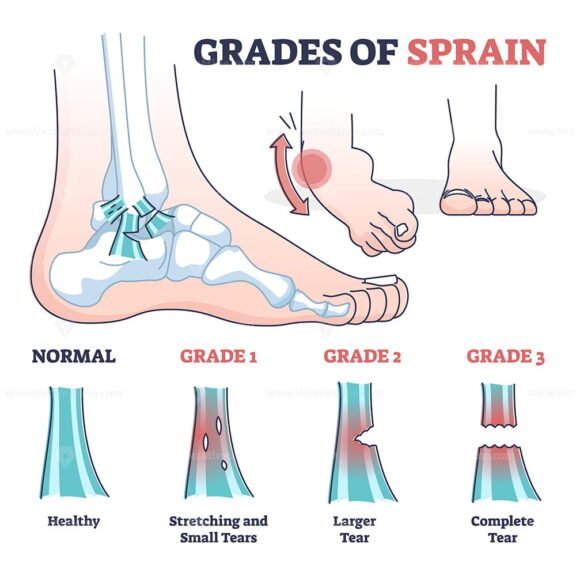 Grades of Sprain outline