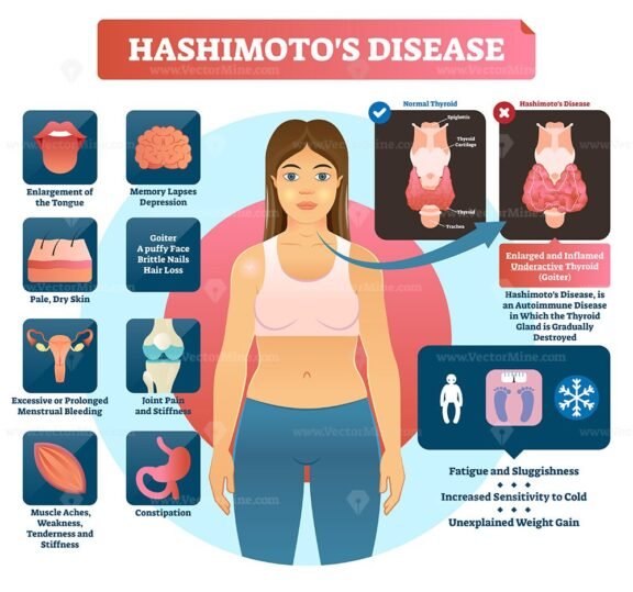 Hashimotos Disease