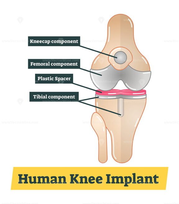 Human Knee Implant