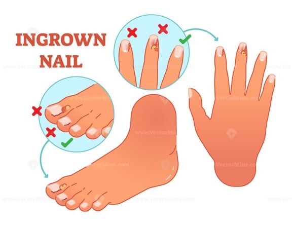 Ingrown Nail