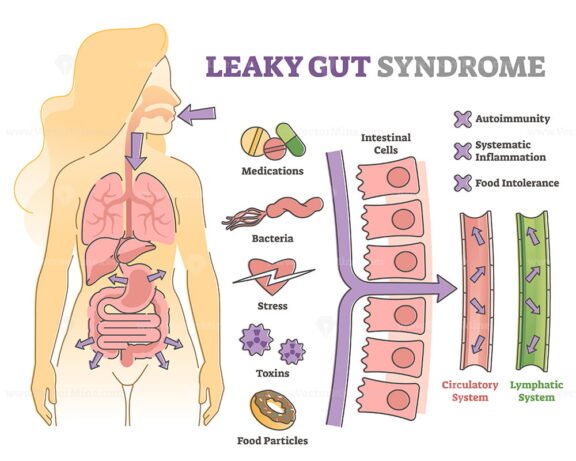 Leaky Gut Outline