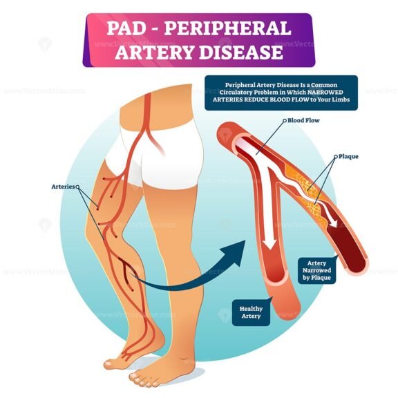 PAD Peripheral Artery Disease