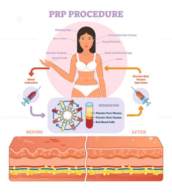 PRP Procedure