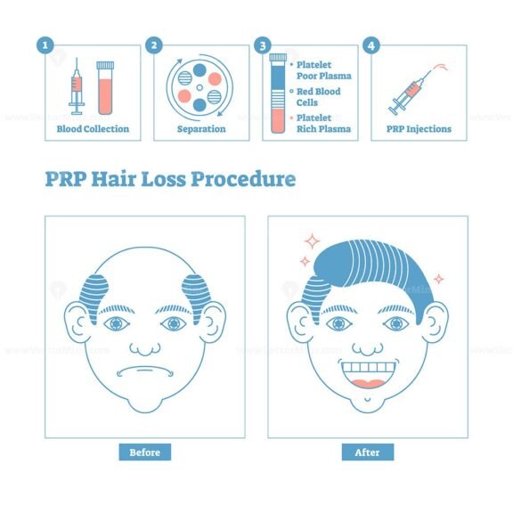 PRP hair procedure linestyle