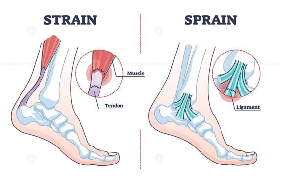 Sprain VS Strain outline