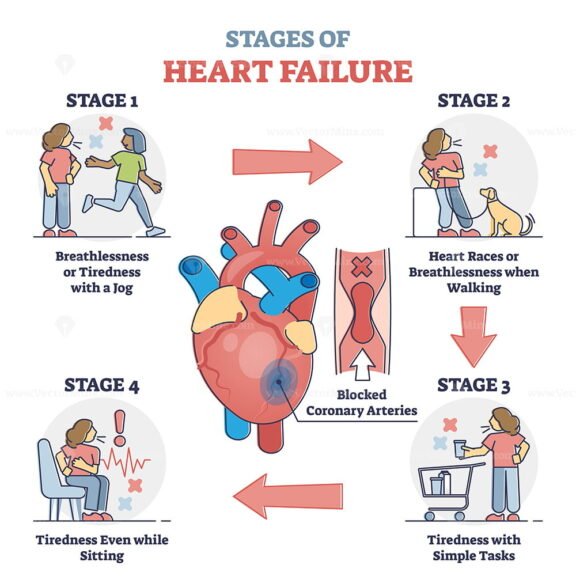 Stages of Heart Failure outline