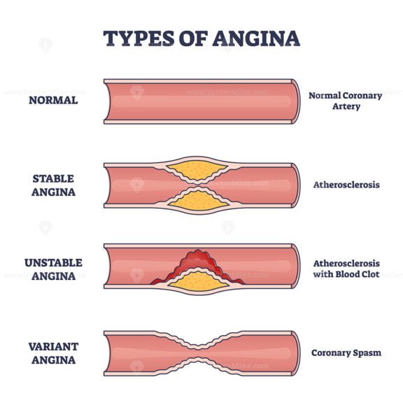 Types of Angina outline diagram