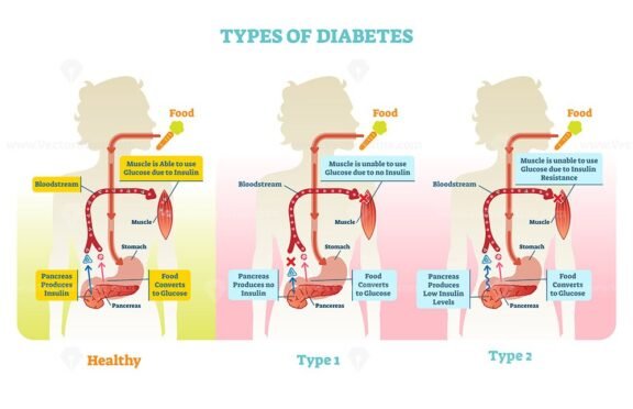 Types of Diabetes 1
