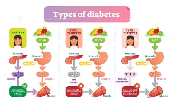 Types of Diabetes 2