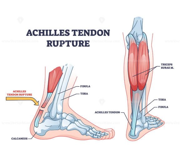 achilles tendon rupture outline 1