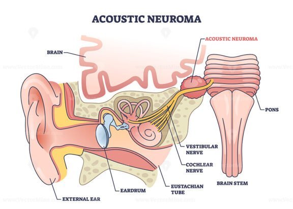 acoustic neuroma outline diagram 1