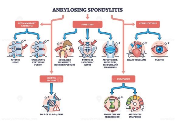 ankylosing spondylitis diagram outline 1