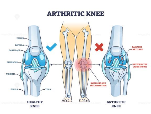 arthritic knee outline diagram 1