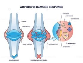 arthritis immune response outline 1