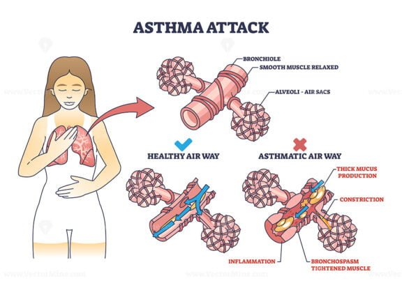 asthma attack outline diagram 1