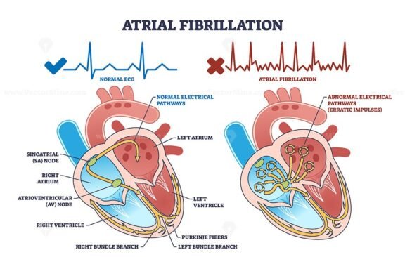 atrial fibrillation outline 1