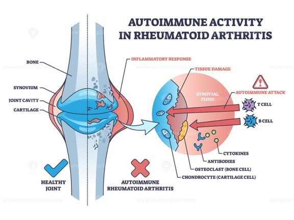 autoimmune activity in rheumatoid arthritis outline 1