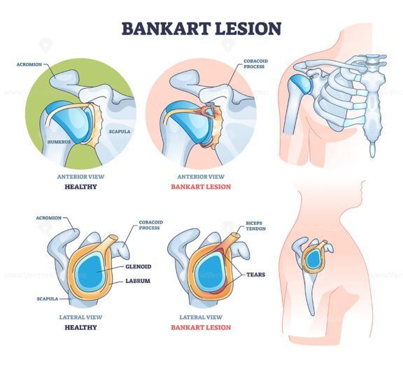 bankart lesion outline diagram 1