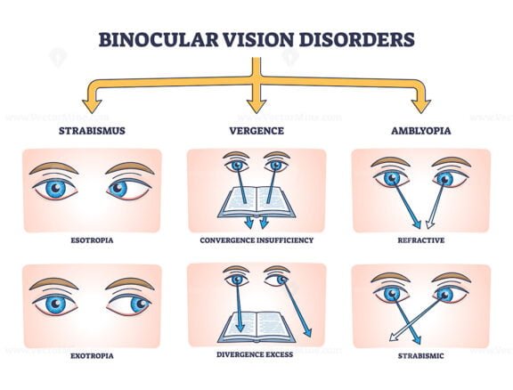 binocular vision disorders outline diagram 1