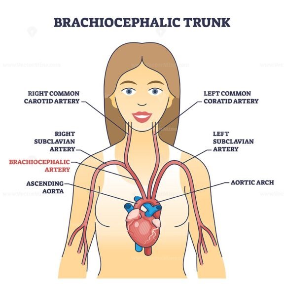 brachiocephalic trunk diagram 1