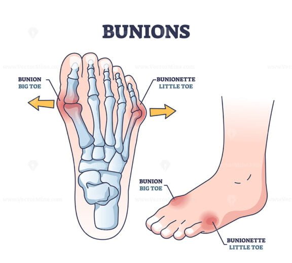 bunions outline 1