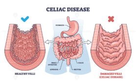 celiac disease v2 outline 1
