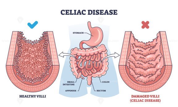 celiac disease v2 outline 1