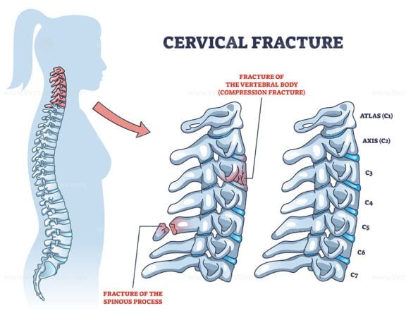 cervical fracture outline 1