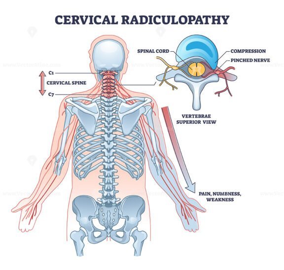 cervical radiculopathy outline 1
