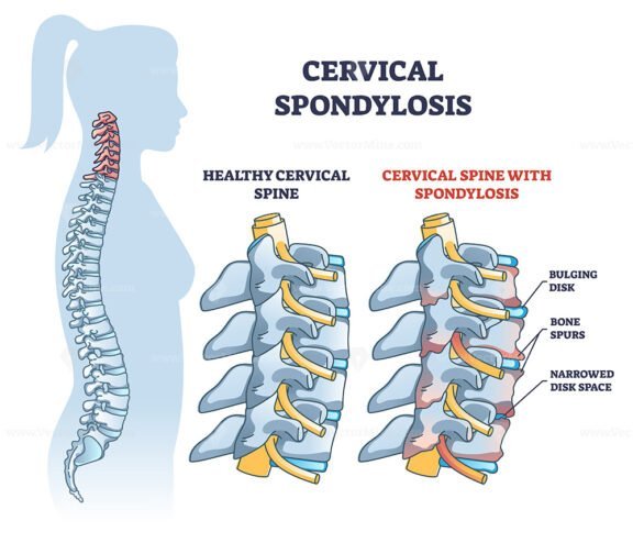 cervical spondylosis outline 1