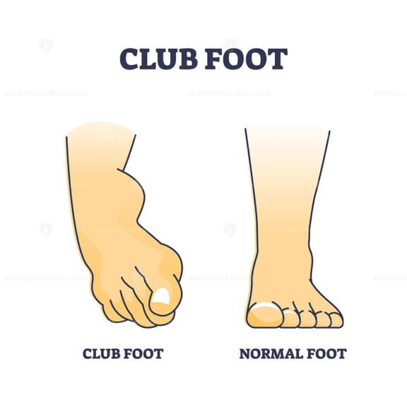 club foot outline 1