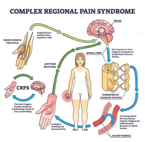 complex regional pain syndrome outline 1