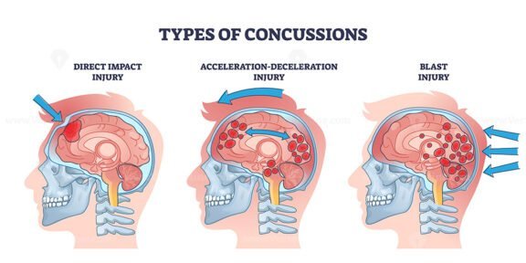 concussion 2 outline 1