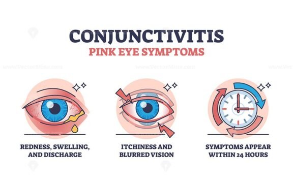 conjunctivitis pink eye symptoms v2 short outline diagram 1