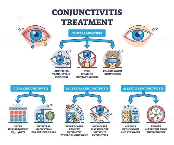 conjunctivitis treatment outline diagram 1